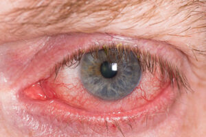 A very bloodshot and irritated eye.